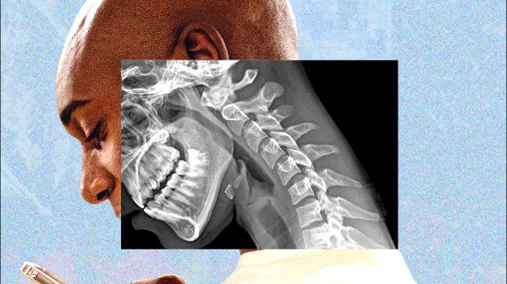 A man looking down, with an X-ray window transposed on his face, showing the curvature of his neck